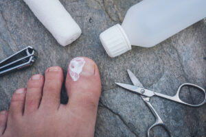shot of a toe with cream on it and surrounded by bandage, scissors, isopropyl, and toenail clippers.