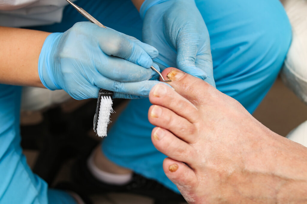 Doctor treats an ingrown toenail with a medical instrument