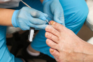 Doctor treats an ingrown toenail with a medical instrument
