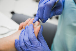 close up of ingrown toe nail surgery